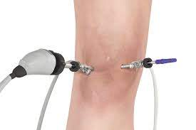 Knee Joint Arthroscopy