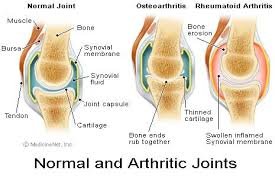 Normal and Arthritic Joints