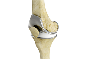 Total Knee Replacement TKR