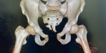 Pelvic Bone Fracture with Sacrailiac Joint and Sacrum Fractures